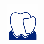 Laminate veneers